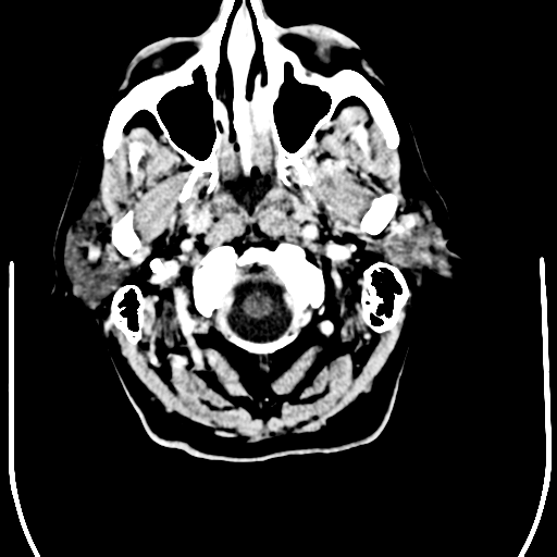 File:Anaplastic meningioma with recurrence (Radiopaedia 34452-35781 Axial Contrast 1).png