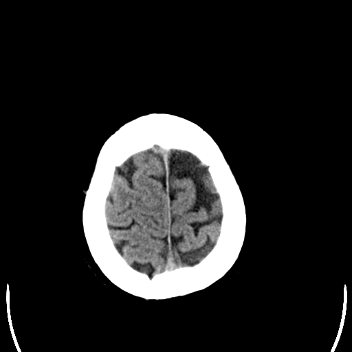 File:Anaplastic meningioma with recurrence (Radiopaedia 34452-35781 Axial non-contrast 30).png