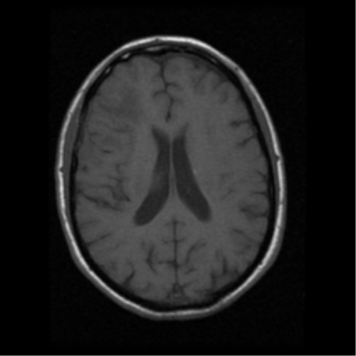 File:Anaplastic meningioma with recurrence (Radiopaedia 34452-35783 Axial T1 13).png