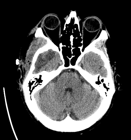 File:Anaplastic meningioma with recurrence (Radiopaedia 34452-35786 Axial non-contrast 10).png