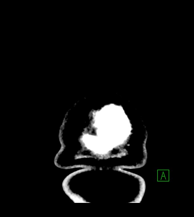 Anaplastic oligodendroglioma (Radiopaedia 79571-92753 Coronal non-contrast 72).jpg