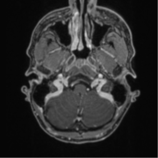 Anaplastic oligodendroglioma with skull fracture (Radiopaedia 74831-85845 Axial T1 C+ fat sat 3).png