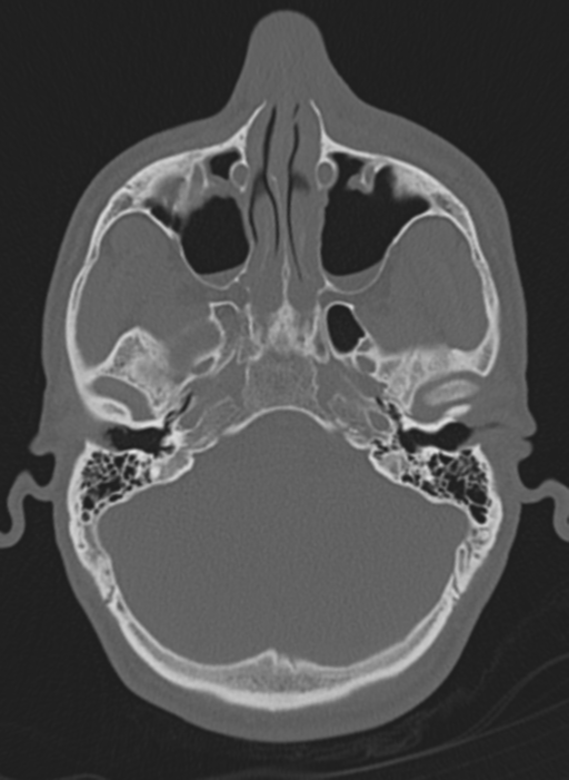 Anaplastic oligodendroglioma with skull fracture (Radiopaedia 74831-85846 Axial bone window 63).png