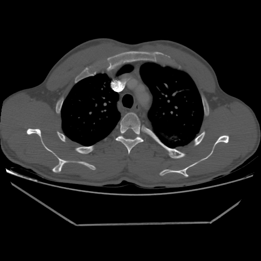 Aneurysmal bone cyst - rib (Radiopaedia 82167-96220 Axial bone window 89).jpg