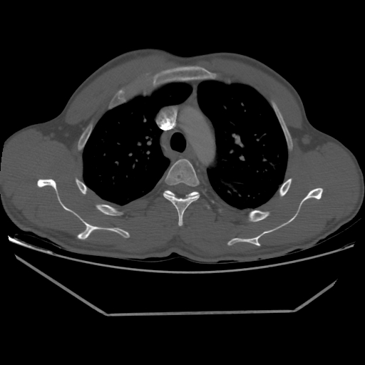 Aneurysmal bone cyst - rib (Radiopaedia 82167-96220 Axial bone window 94).jpg