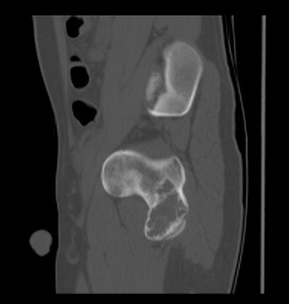 Aneurysmal bone cyst of ischium (Radiopaedia 25957-26094 Sagittal bone window 51).png