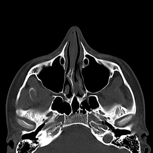 Aneurysmal bone cyst of the mandible (Radiopaedia 43280-46601 Axial bone window 78).jpg