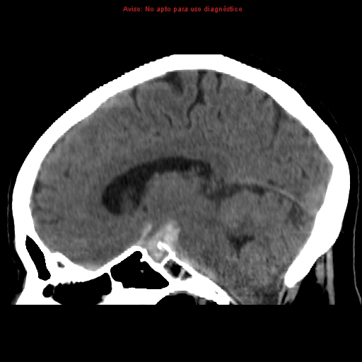 File:Aneurysmal subarachnoid hemorrhage (Radiopaedia 24740-24997 non-contrast 24).jpg