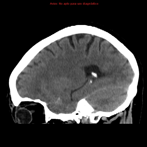 File:Aneurysmal subarachnoid hemorrhage (Radiopaedia 24740-24997 non-contrast 36).jpg