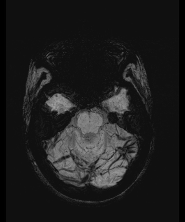 Angiomatous meningioma (Radiopaedia 79459-92579 E 18).jpg