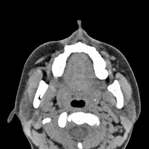 Angular dermoid cyst (Radiopaedia 88967-105790 Axial non-contrast 3).jpg
