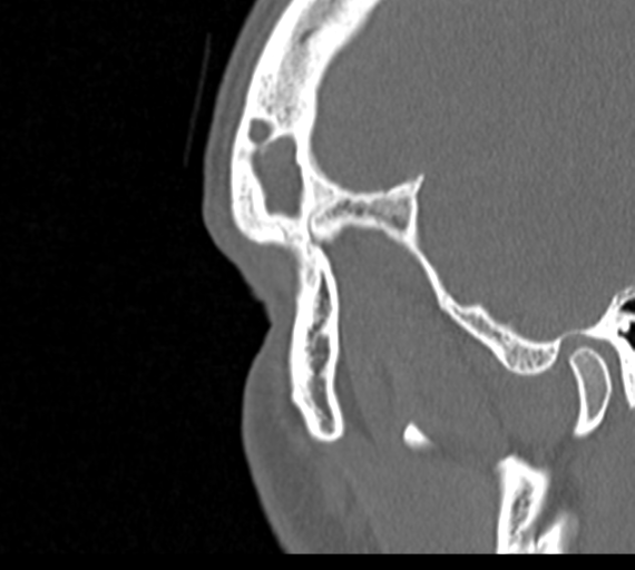 Angular epidermoid cyst (Radiopaedia 46908-51439 Sagittal bone window 90).png