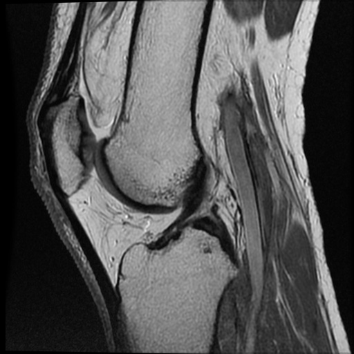 File:Anomalous insertion of the medial meniscus (Radiopaedia 77559-89721 Sagittal PD 25).jpg