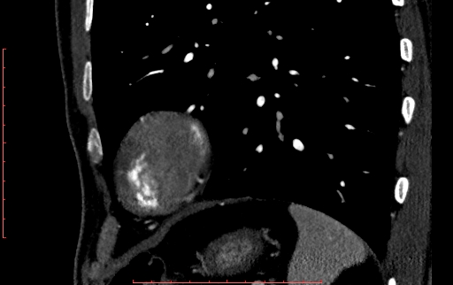 Anomalous left coronary artery from the pulmonary artery (ALCAPA) (Radiopaedia 70148-80181 C 245).jpg