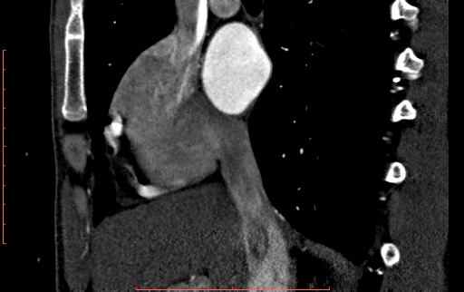 Anomalous left coronary artery from the pulmonary artery (ALCAPA) (Radiopaedia 70148-80181 C 46).jpg