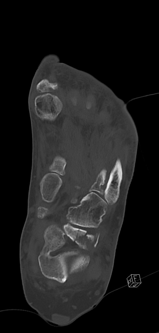 Anterior calcaneal process fracture (Radiopaedia 63353-71943 Coronal bone window 28).jpg
