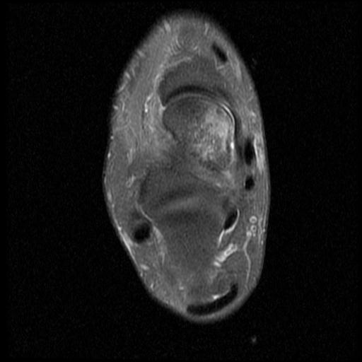 File:Anterior calcaneal process fracture (Radiopaedia 71377-81705 Axial PD fat sat 9).jpg