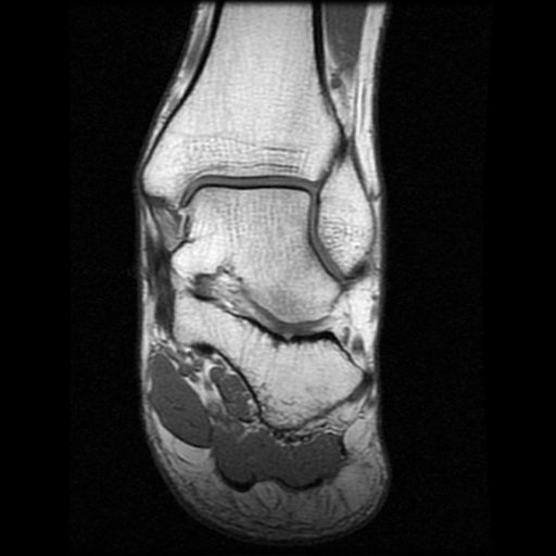 File:Anterior calcaneal process fracture (Radiopaedia 74654-85611 Coronal T1 12).jpg