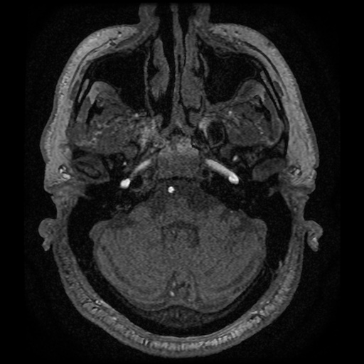 Anterior cerebral artery infarction (Radiopaedia 46794-51323 Axial MRA 18).jpg