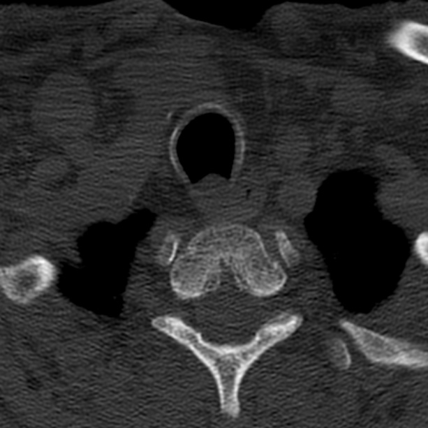 Anterior cervical postdiscectomy arthrodesis (Radiopaedia 32678-33646 Axial bone window 69).jpg