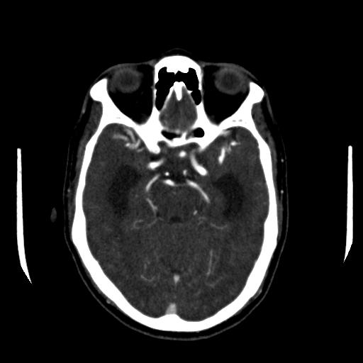 File:Anterior communicating artery aneurysm (Radiopaedia 16633-16335 A 16).jpg