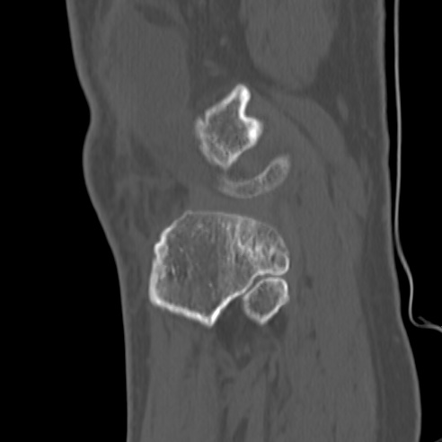 File:Anterior cruciate ligament avulsion fracture (Radiopaedia 58939-66194 Sagittal bone window 6).jpg