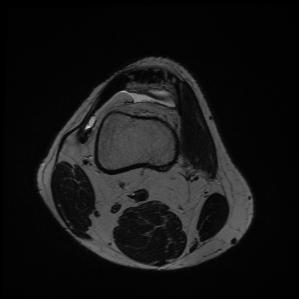File:Anterior cruciate ligament graft tear and bucket-handle tear of medial meniscus (Radiopaedia 75867-87254 Axial T2 25).jpg