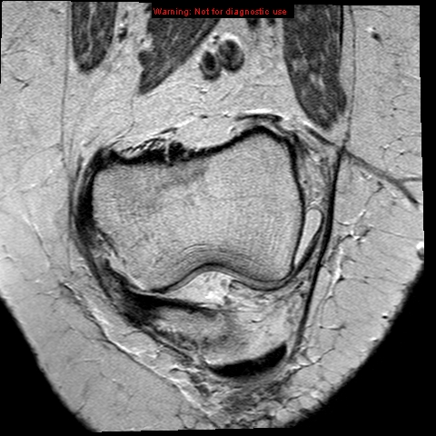 File:Anterior cruciate ligament tear (Radiopaedia 12329-12612 C 2).jpg