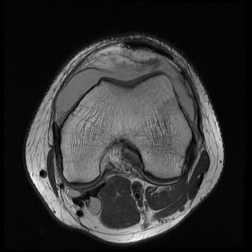 File:Anterior cruciate ligament tear (Radiopaedia 61500-69462 Axial PD 9).jpg