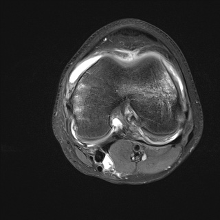 File:Anterior cruciate ligament tear - pediatric (Radiopaedia 62152-70260 Axial PD fat sat 19).jpg