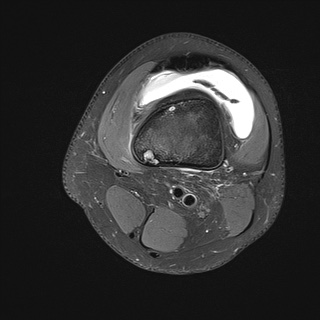 File:Anterior cruciate ligament tear - pediatric (Radiopaedia 62152-70260 Axial PD fat sat 2).jpg
