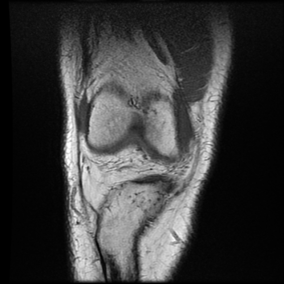 File:Anterior cruciate ligament tear with posteromedial corner injury, bucket-handle meniscal tear and chondral delamination (Radiopaedia 75501-86744 Coronal T1 7).jpg