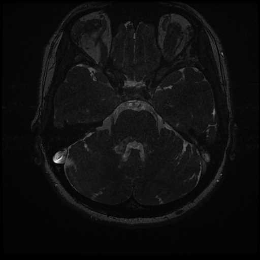 Anterior inferior cerebellar artery vascular loop - type II (Radiopaedia 70991-81209 Axial 3D FIESTA 13).jpg