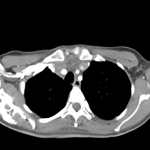 Anterior mediastinal lymphoma (Radiopaedia 29556-30061 C 11).jpg