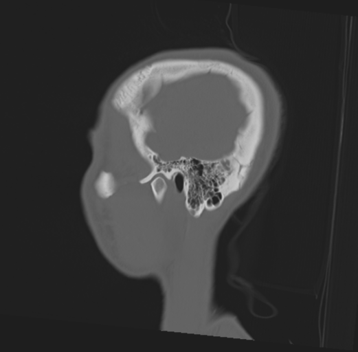 Anterior nasal spine fracture (Radiopaedia 46138-50494 Sagittal bone window 48).png