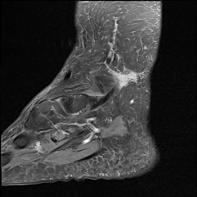 File:Anterior talofibular ligament injury - rupture with soft-tissue impingement (Radiopaedia 38765-40928 Sagittal PD fat sat 2).jpg