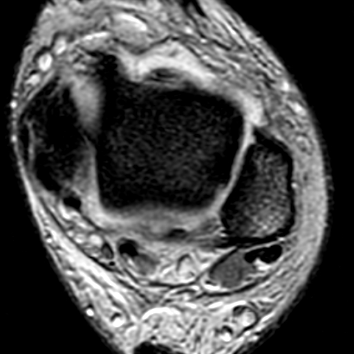 File:Anterior talofibular ligament rupture (Radiopaedia 15831-15484 Axial T2* 8).jpg