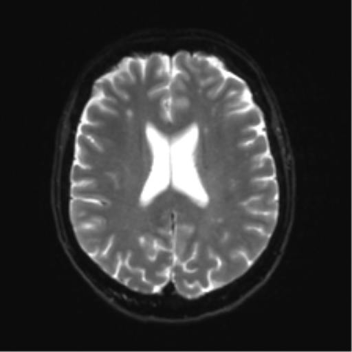 Anterior temporal lobe perivascular space (Radiopaedia 40946-43650 Axial DWI 17).png