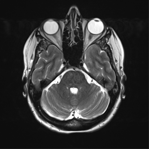 File:Anterior temporal lobe perivascular space (Radiopaedia 40946-43650 Axial T2 11).png