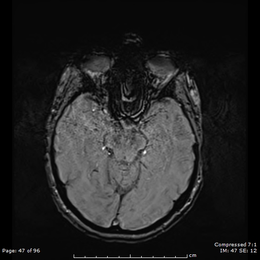 File:Anterior temporal lobe perivascular space (Radiopaedia 88283-104914 Axial SWI 16).jpg