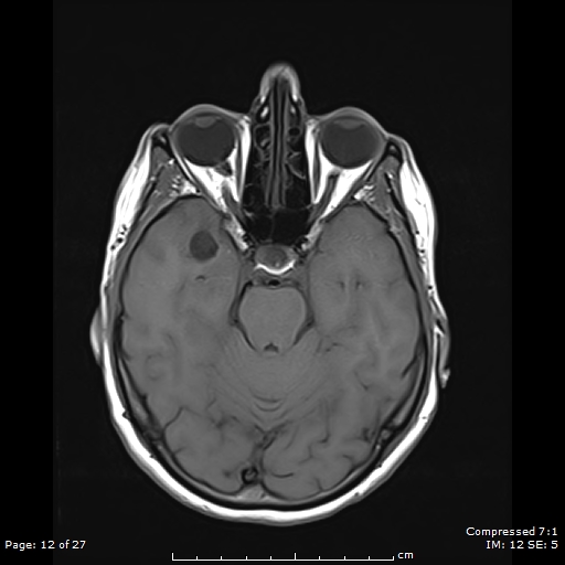 File:Anterior temporal lobe perivascular space (Radiopaedia 88283-104914 Axial T1 12).jpg