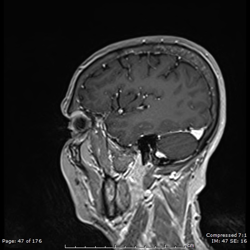 File:Anterior temporal lobe perivascular space (Radiopaedia 88283-104914 Sagittal T1 C+ 8).jpg