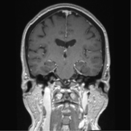 Anterior temporal pole cysts (Radiopaedia 46629-51102 Coronal T1 C+ 82).png