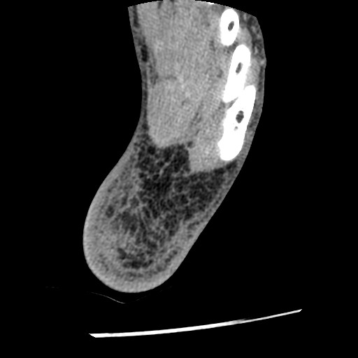 Anterior tibial artery false aneurysm (Radiopaedia 88984-105809 A 240).jpg
