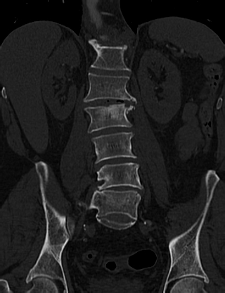 Anterior vertebral scalloping (abdominal aortic aneurysm) (Radiopaedia 66744-76067 Coronal bone window 38).jpg
