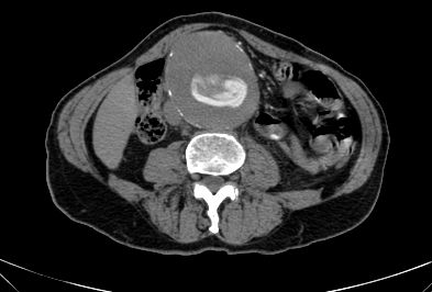 Anterior vertebral scalloping (abdominal aortic aneurysm) (Radiopaedia 66744-76067 F 49).jpg