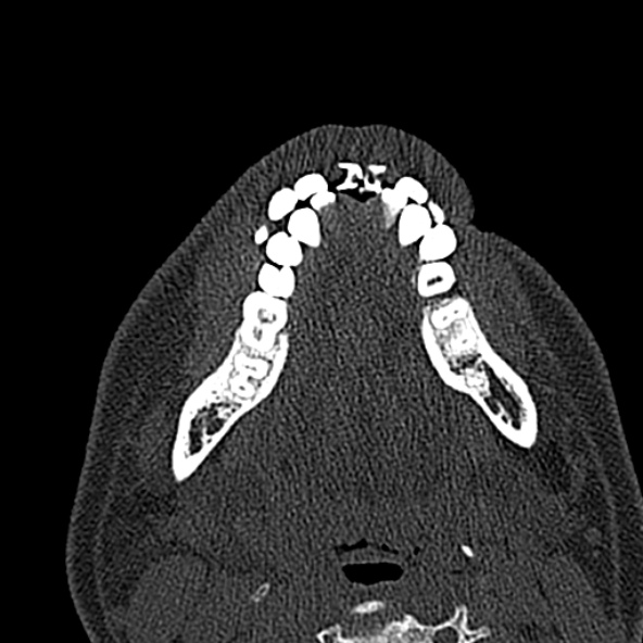 Antrochoanal polyp (Radiopaedia 30002-30554 Axial bone window 5).jpg