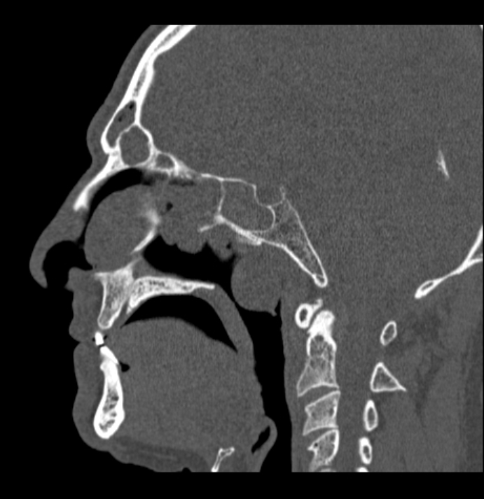 Antrochoanal polyp (Radiopaedia 79011-92169 Sagittal bone window 32).jpg