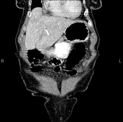 File:Aortic aneurysm and Lemmel syndrome (Radiopaedia 86499-102554 C 10).jpg