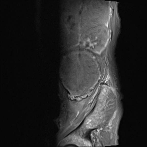 File:Aortic aneurysm with spinal destruction (Radiopaedia 42301-45409 Sagittal T1 fat sat 10).jpg